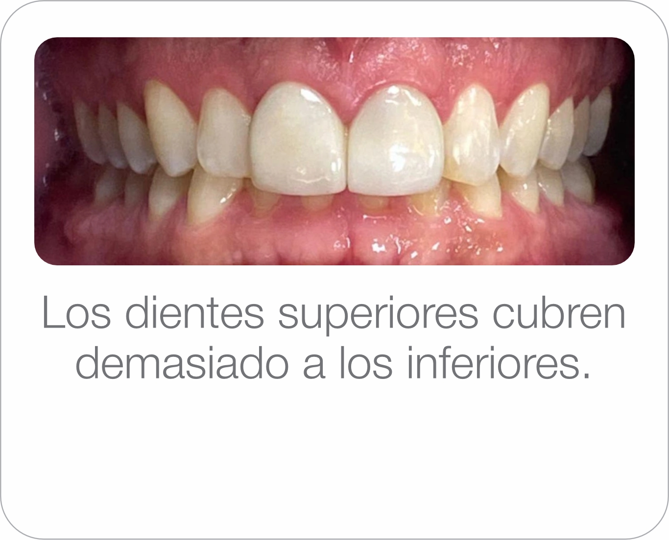 Caso real - Mordida profunda